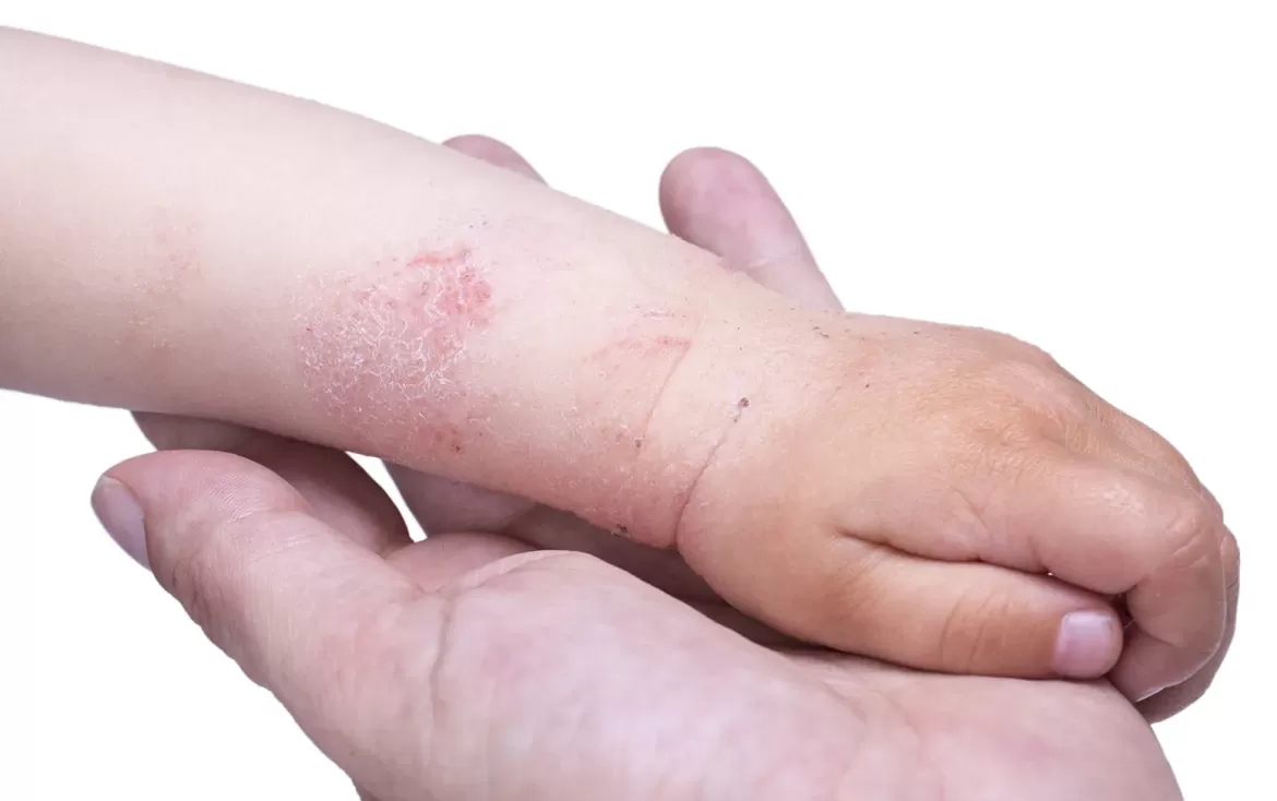 dermatite atopica braccio bambini