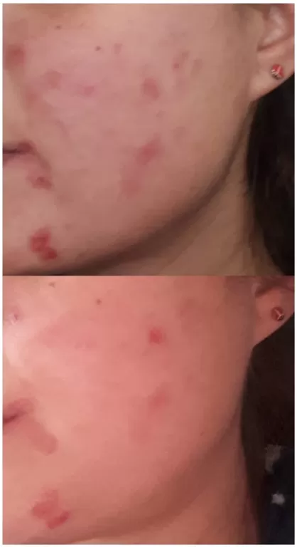 prima e dopo la cura di dermatite atopica
