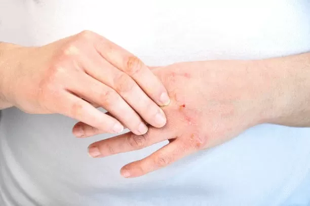 mani con forte prurito e rossore per dermatite atopica