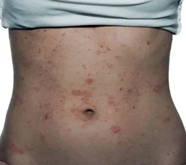 Allergia al Nichel Sintomi