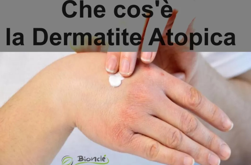 Che cos'è la Dermatite Atopica